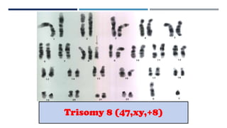 Trisomy 8 (47,xy,+8)
 