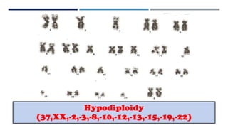 Hypodiploidy
(37,XX,-2,-3,-8,-10,-12,-13,-15,-19,-22)
 