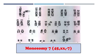 Monosomy 7 (45,xx,-7)
 