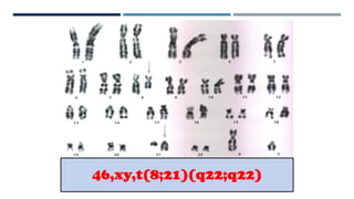 46,xy,t(8;21)(q22;q22)
 