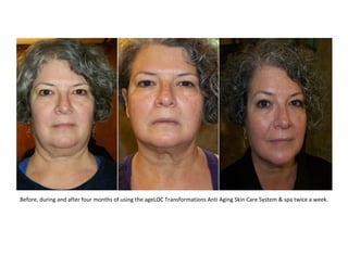 Before, during and after four months of using the ageLOC Transformations Anti Aging Skin Care System & spa twice a week.
 