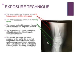 +
EXPOSURE TECHNIQUE
 The most radiolucent structure is the soft
tissue margins and the joint space
 The most radiopaque structure is the bony
cortex
 The images contrast is more on the grey
side therefore it has long scale contrast
 Since there is no EI value present it is
difficult to determine if the image is
adequately exposed
 Since I took the image and it was
accepted by the techs, it is in normal
range of the hospital EI values, and is
adequately exposed !! But it should be
short scale contrast (black & white) and
the image looks more long scale (grey)
 