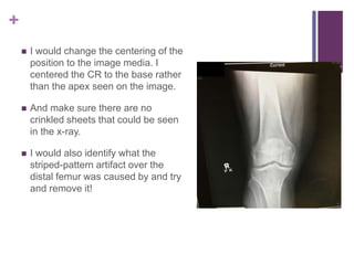 +
 I would change the centering of the
position to the image media. I
centered the CR to the base rather
than the apex seen on the image.
 And make sure there are no
crinkled sheets that could be seen
in the x-ray.
 I would also identify what the
striped-pattern artifact over the
distal femur was caused by and try
and remove it!
 