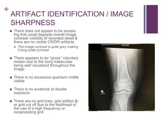 +
ARTIFACT IDENTIFICATION / IMAGE
SHARPNESS
 There does not appear to be excess
fog that could degrade overall image
contrast/ visibility of recorded detail &
there are no visible CR/DR artifacts
 The image contrast is quite grey making
it long scale contrast
 There appears to be “gross” voluntary
motion due to the bony trabeculae
being well visualized throughout the
image
 There is no excessive quantum mottle
visible
 There is no evidence of double
exposure
 There are no grid lines, grid artifact &/
or grid cut off due to the likelihood of
the use of a high frequency or
reciprocating grid
 
