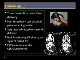 Follow up…. 
 Tumor resection done after 
delivery 
 Post resection – Left occipital 
pseudomeningocoele 
 2yrs later admitted for second 
delivery 
 Had Functioning VP shunt / no 
signs of raised ICP 
 LSCS was done under 
CSEA/Uneventful 
 