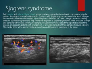 Sjogren Reticular Pattern Ultrasound uses in dentistry - medical dental approach | PPTX