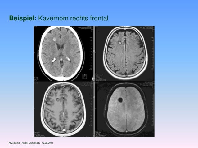 Kavernöse Transformation: Kavernöse Transformation Erklärung ...