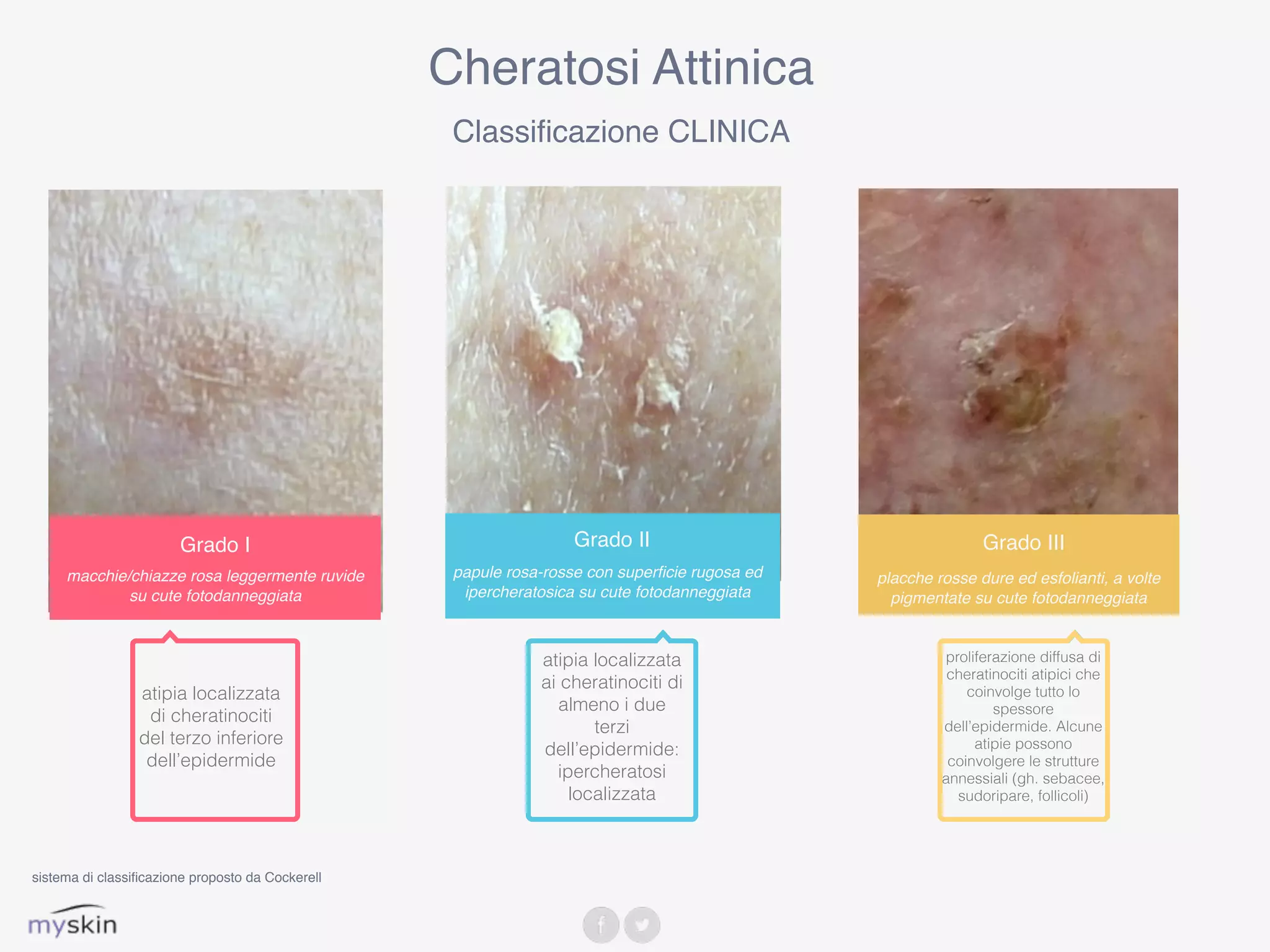 Grado I
macchie/chiazze rosa leggermente ruvide
su cute fotodanneggiata
Cheratosi Attinica
Classificazione CLINICA
Grado II
papule rosa-rosse con superficie rugosa ed
ipercheratosica su cute fotodanneggiata
Grado III
placche rosse dure ed esfolianti, a volte
pigmentate su cute fotodanneggiata
atipia localizzata
di cheratinociti
del terzo inferiore
dell’epidermide
atipia localizzata
ai cheratinociti di
almeno i due
terzi
dell’epidermide:
ipercheratosi
localizzata
proliferazione diffusa di
cheratinociti atipici che
coinvolge tutto lo
spessore
dell’epidermide. Alcune
atipie possono
coinvolgere le strutture
annessiali (gh. sebacee,
sudoripare, follicoli)
sistema di classificazione proposto da Cockerell
 