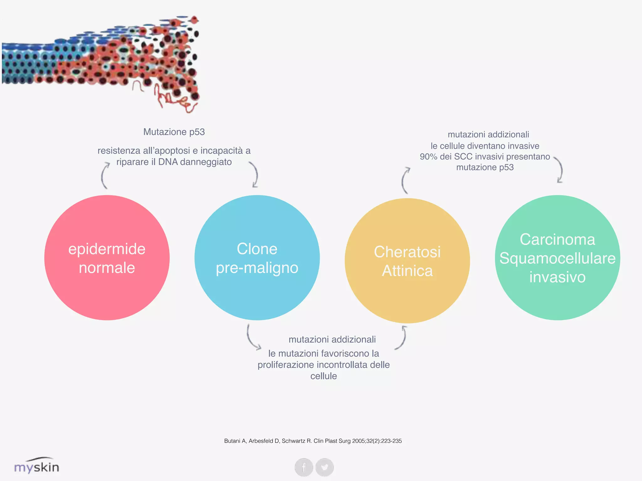 epidermide
normale
Mutazione p53
resistenza all’apoptosi e incapacità a
riparare il DNA danneggiato
Clone
pre-maligno
Cheratosi
Attinica
Carcinoma
Squamocellulare
invasivo
mutazioni addizionali
le mutazioni favoriscono la
proliferazione incontrollata delle
cellule
mutazioni addizionali
le cellule diventano invasive
90% dei SCC invasivi presentano
mutazione p53
Butani A, Arbesfeld D, Schwartz R. Clin Plast Surg 2005;32(2):223-235
 
