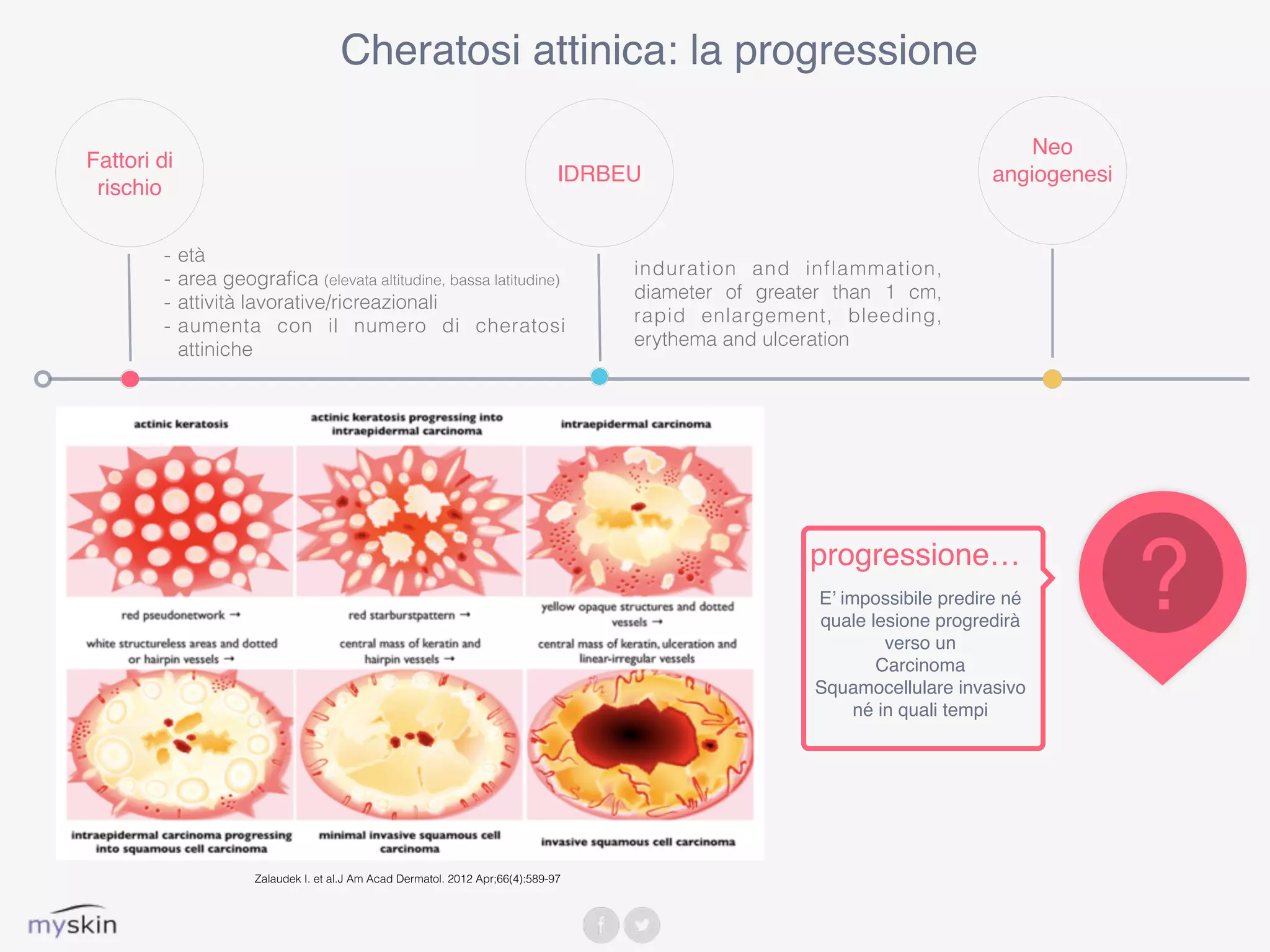 Cheratosi attinica: la progressione
IDRBEU
induration and inflammation,
diameter of greater than 1 cm,
rapid enlargement, bleeding,
erythema and ulceration
Neo
angiogenesi
Fattori di
rischio
- età
- area geografica (elevata altitudine, bassa latitudine)
- attività lavorative/ricreazionali
- aumenta con il numero di cheratosi
attiniche
Zalaudek I. et al.J Am Acad Dermatol. 2012 Apr;66(4):589-97
?progressione…
E’ impossibile predire né
quale lesione progredirà
verso un
Carcinoma
Squamocellulare invasivo
né in quali tempi
 