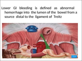 Lower GI bleeding is defined as abnormal
hemorrhage into the lumen of the bowel from a
source distal to the ligament of Treitz
 