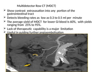Multidetector Row CT (MDCT)
 Show contrast extravasation into any portion of the
gastrointestinal tract
 Detects bleeding rates as low as 0.3 to 0.5 ml per minute
 The average yield of MDCT for lower GI bleed Is 60%, with yields
ranging from 25% to 95%.
 Lack of therapeutic capability is a major limitation
 Useful in guiding further:angioembolisation
 