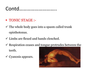 Contd………………………..
 TONIC STAGE :-
 The whole body goes into a spasm called trunk
opisthotonus.
 Limbs are flexed and hands clenched.
 Respiration ceases and tongue protrudes between the
teeth.
 Cyanosis appears.
 