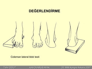 DEĞERLENDİRME




     Coleman lateral blok testi



Tahir ÖĞÜT            KAVOVARUS AYAK   20. Milli Kongre Ankara 2007
 