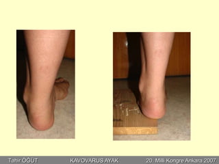 Tahir ÖĞÜT   KAVOVARUS AYAK   20. Milli Kongre Ankara 2007
 