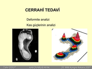 CERRAHİ TEDAVİ

             Deformite analizi
             Kas güçlerinin analizi




Tahir ÖĞÜT     KAVOVARUS AYAK         20. Milli Kongre Ankara 2007
 