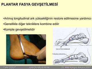 PLANTAR FASYA GEVŞETİLMESİ


•Artmış longitudinal ark yüksekliğinin restore edilmesine yardımcı
•Genellikle diğer tekniklere kombine edilir
•Komple gevşetilmelidir




Tahir ÖĞÜT          KAVOVARUS AYAK            20. Milli Kongre Ankara 2007
 