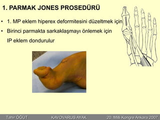 1. PARMAK JONES PROSEDÜRÜ

• 1. MP eklem hiperex deformitesini düzeltmek için
• Birinci parmakta sarkaklaşmayı önlemek için
  IP eklem dondurulur




  Tahir ÖĞÜT        KAVOVARUS AYAK         20. Milli Kongre Ankara 2007
 