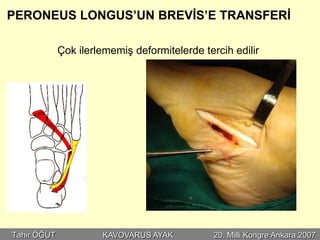 PERONEUS LONGUS’UN BREVİS’E TRANSFERİ

             Çok ilerlememiş deformitelerde tercih edilir




Tahir ÖĞÜT            KAVOVARUS AYAK           20. Milli Kongre Ankara 2007
 