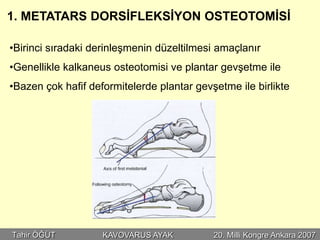 1. METATARS DORSİFLEKSİYON OSTEOTOMİSİ

•Birinci sıradaki derinleşmenin düzeltilmesi amaçlanır
•Genellikle kalkaneus osteotomisi ve plantar gevşetme ile
•Bazen çok hafif deformitelerde plantar gevşetme ile birlikte




Tahir ÖĞÜT          KAVOVARUS AYAK          20. Milli Kongre Ankara 2007
 
