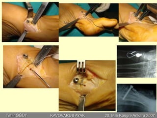 Tahir ÖĞÜT   KAVOVARUS AYAK   20. Milli Kongre Ankara 2007
 