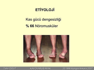 ETİYOLOJİ

             Kas gücü dengesizliği
             % 66 Nöromusküler




Tahir ÖĞÜT     KAVOVARUS AYAK        20. Milli Kongre Ankara 2007
 