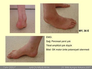 MY, 36 E

                        EMG:
                        Sağ: Peroneal yanıt yok
                        Tibial amplitüd çok düşük
                        Bilat: GK motor ünite potansiyeli izlenmedi




Tahir ÖĞÜT   KAVOVARUS AYAK            20. Milli Kongre Ankara 2007
 