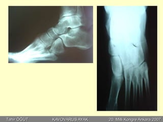 Tahir ÖĞÜT   KAVOVARUS AYAK   20. Milli Kongre Ankara 2007
 