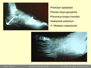 •Perkütan aşiloplasti
                              •Plantar fasya gevşetme
                              •Peroneus longus transferi
                              •Kalkaneal osteotomi
                              •1. Metatars osteotomisi




Tahir ÖĞÜT   KAVOVARUS AYAK            20. Milli Kongre Ankara 2007
 