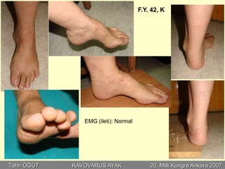 F.Y. 42, K




                EMG (ileti): Normal




Tahir ÖĞÜT   KAVOVARUS AYAK               20. Milli Kongre Ankara 2007
 