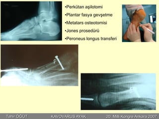 •Perkütan aşilotomi
                  •Plantar fasya gevşetme
                  •Metatars osteotomisi
                  •Jones prosedürü
                  •Peroneus longus transferi




Tahir ÖĞÜT   KAVOVARUS AYAK             20. Milli Kongre Ankara 2007
 