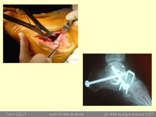 Tahir ÖĞÜT   KAVOVARUS AYAK   20. Milli Kongre Ankara 2007
 