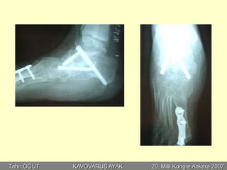 Tahir ÖĞÜT   KAVOVARUS AYAK   20. Milli Kongre Ankara 2007
 