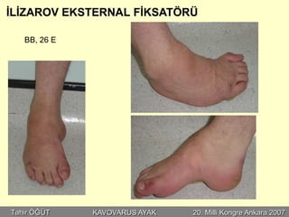 İLİZAROV EKSTERNAL FİKSATÖRÜ

   BB, 26 E




Tahir ÖĞÜT    KAVOVARUS AYAK   20. Milli Kongre Ankara 2007
 