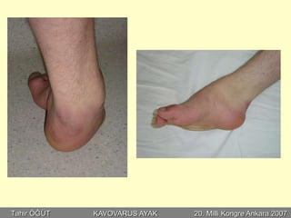 Tahir ÖĞÜT   KAVOVARUS AYAK   20. Milli Kongre Ankara 2007
 