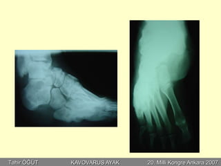 Tahir ÖĞÜT   KAVOVARUS AYAK   20. Milli Kongre Ankara 2007
 