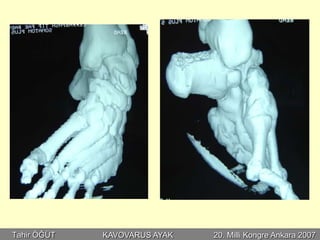 Tahir ÖĞÜT   KAVOVARUS AYAK   20. Milli Kongre Ankara 2007
 