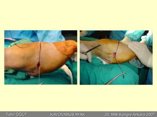 Tahir ÖĞÜT   KAVOVARUS AYAK   20. Milli Kongre Ankara 2007
 