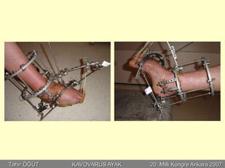 Tahir ÖĞÜT   KAVOVARUS AYAK   20. Milli Kongre Ankara 2007
 