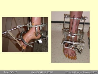 Tahir ÖĞÜT   KAVOVARUS AYAK   20. Milli Kongre Ankara 2007
 