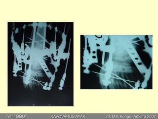 Tahir ÖĞÜT   KAVOVARUS AYAK   20. Milli Kongre Ankara 2007
 