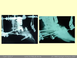 Tahir ÖĞÜT   KAVOVARUS AYAK   20. Milli Kongre Ankara 2007
 