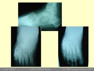 Tahir ÖĞÜT   KAVOVARUS AYAK   20. Milli Kongre Ankara 2007
 