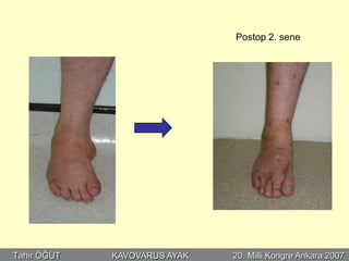 Postop 2. sene




Tahir ÖĞÜT   KAVOVARUS AYAK   20. Milli Kongre Ankara 2007
 