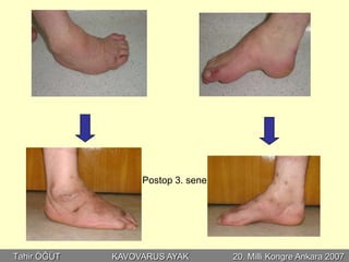 Postop 3. sene




Tahir ÖĞÜT   KAVOVARUS AYAK        20. Milli Kongre Ankara 2007
 
