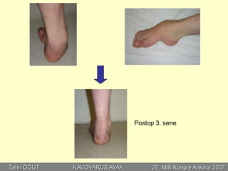 Postop 3. sene




Tahir ÖĞÜT   KAVOVARUS AYAK        20. Milli Kongre Ankara 2007
 