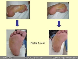Postop 1. sene




Tahir ÖĞÜT   KAVOVARUS AYAK       20. Milli Kongre Ankara 2007
 