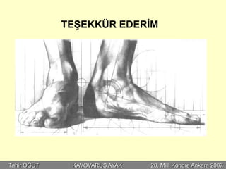 TEŞEKKÜR EDERİM




Tahir ÖĞÜT    KAVOVARUS AYAK   20. Milli Kongre Ankara 2007
 