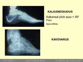 KALKANEOKAVUS
                              Kalkaneal pitch açısı > 300
                              Polyo
                              Spina Bifida




                                   KAVOVARUS




Tahir ÖĞÜT   KAVOVARUS AYAK            20. Milli Kongre Ankara 2007
 