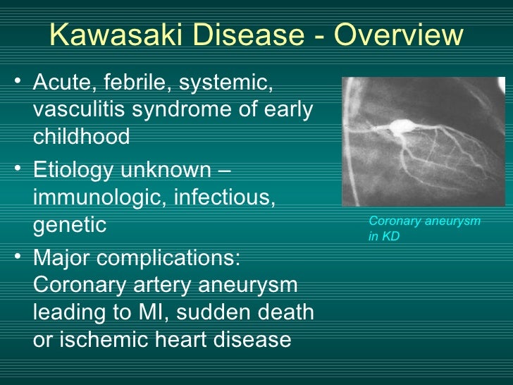 Etanercept in Kawasaki Disease Clinical Trial Overview
